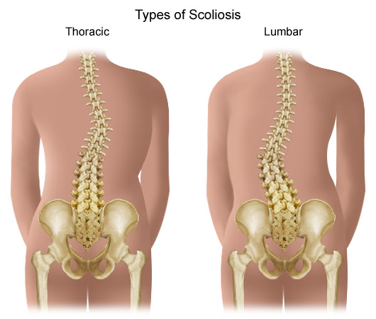 Scoliosis